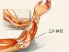 夜间被胳膊麻醒，你可能得了这个病~