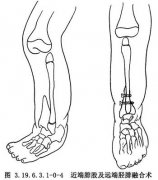 腓总神经受损后怎么康复？教你几个护理小妙招