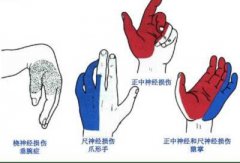 臂丛神经损伤原因有哪些？还能治好吗？