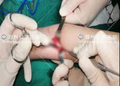 肘管综合征怎么治？仁济专家告诉你