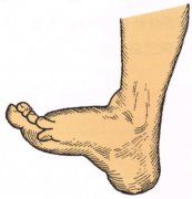 腓总神经损伤多久能好