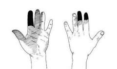 正中神经损伤会造成哪些肌肉萎缩