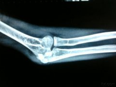 哪些原因会引起肘管综合征呢