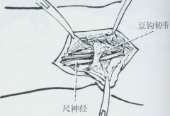 爪形手是怎么一回事，该如何治疗好