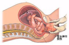 新生儿臂丛神经损伤多久能恢复呢