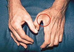 虎口肌肉萎缩？警惕正中神经损伤