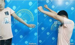 儿童臂丛神经损伤治疗方式有哪些