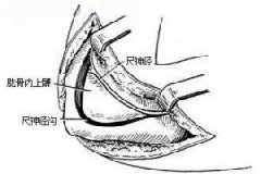 尺神经卡压有何表现？病因有哪些呢